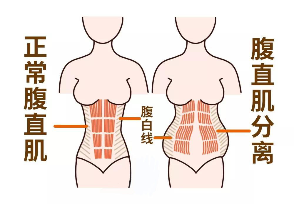 产后修复科学指南，腹直肌分离与盆底肌渐进激活策略